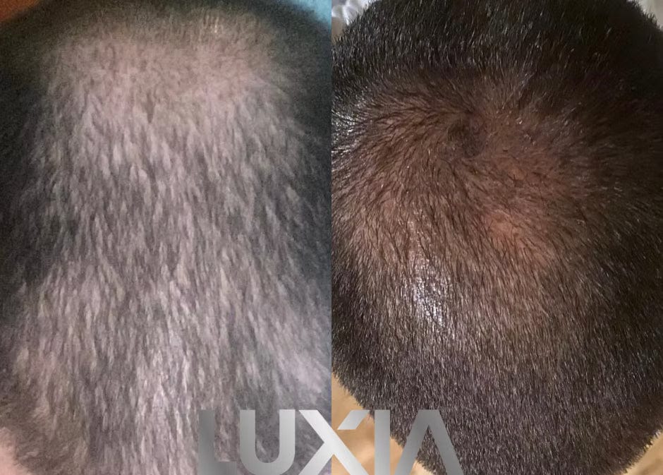 LUXIA Exosomes Hair+ 1 x 5ml - hair before and after treatment showing hair growth