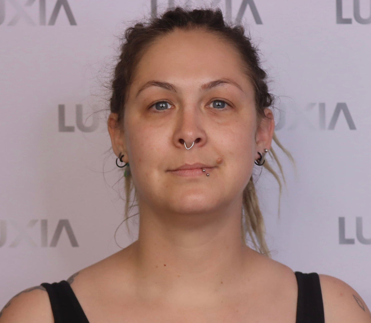 LUXIA Fat Dissolver 5 x 10ml - image of woman before using product